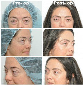 plastic surgery in miami, eyelid surgery in Miami, eye surgery in miami, facial rejuvenation in miami,