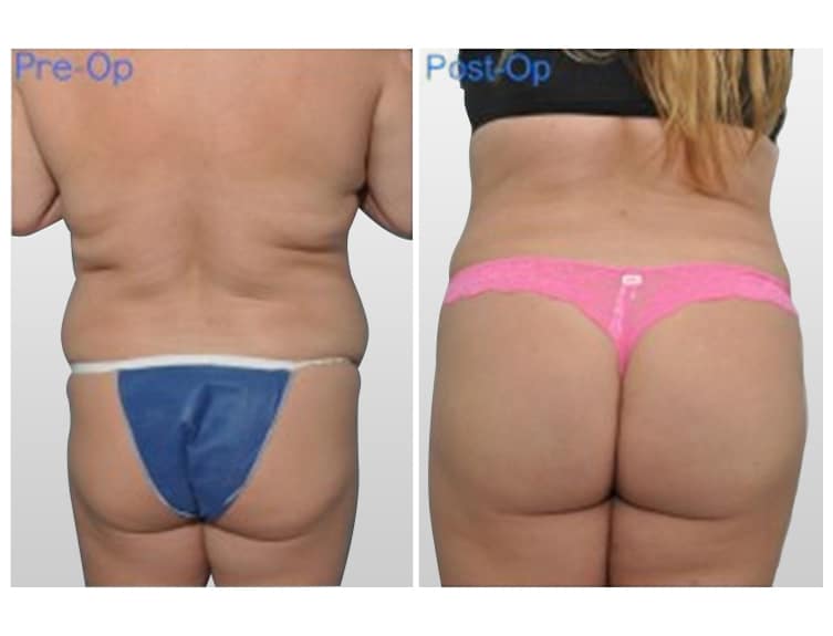 Plastic Surgery Miami, Board certified Plastic Surgeon Miami, Best Plastic Surgeons in Miami, Plastic Surgery Center Miami, Liposuction in Miami