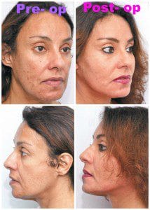 plastic surgery in miami, injectable dermal filler in miami, dermal filler in miami, facial rejuvenation in miami, facial rejuvenation with plasma in miami