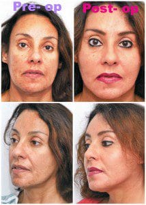 plastic surgery in miami, injectable dermal filler in miami, dermal filler in miami, facial rejuvenation in miami, facial rejuvenation with plasma in miami