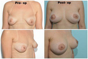 plastic surgery in miami, breast lift in miami, breast reduction in miami, liposuction in miami, laser liposuction in miami, liposculpture in miami, smartlipo in miami, abdomen reduction in miami, tummy tuck in miami, abdominoplasty in miami,