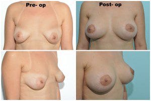 plastic surgery in miami, breast lift in miami, breast reduction in miami, liposuction in miami, laser liposuction in miami, liposculpture in miami, smartlipo in miami, abdomen reduction in miami, tummy tuck in miami, abdominoplasty in miami, 