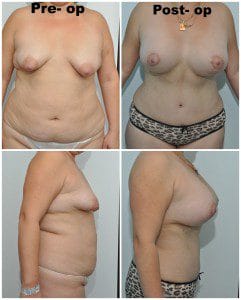 plastic surgery in miami, breast lift in miami, breast reduction in miami, liposuction in miami, laser liposuction in miami, liposculpture in miami, smartlipo in miami, abdomen reduction in miami, tummy tuck in miami, abdominoplasty in miami, 