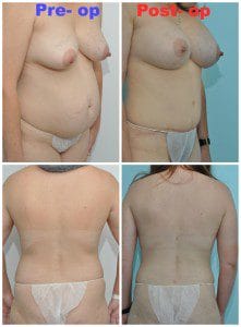 plastic surgery in miami, breast augmentation in miami, transumbilical breast augmentation in miami, abdomen reduction in miami, tummy tuck in miami, abdominoplasty in miami, liposuction in miami,