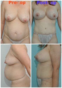 plastic surgery in miami, breast augmentation in miami, transumbilical breast augmentation in miami, abdomen reduction in miami, tummy tuck in miami, abdominoplasty in miami, liposuction in miami,