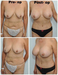 plastic surgery in miami, breast augmentation in miami, transumbilical breast augmentation in miami, abdomen reduction in miami, tummy tuck in miami, abdominoplasty in miami, liposuction in miami,