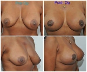 plastic surgery in miami, breast augmentation in miami, abdomen reduction in miami, tummy tuck in miami, abdominoplasty in miami, liposuction in miami, laser liposuction in miami, liposculpture in miami, smartlipo in miami, 