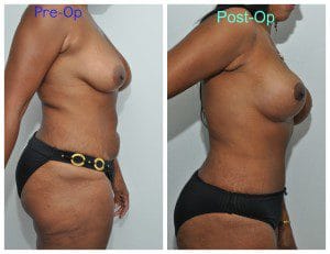 plastic surgery in miami, breast augmentation in miami, abdomen reduction in miami, tummy tuck in miami, abdominoplasty in miami, liposuction in miami, laser liposuction in miami, liposculpture in miami, smartlipo in miami, 