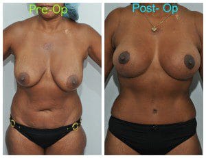 plastic surgery in miami, breast augmentation in miami, abdomen reduction in miami, tummy tuck in miami, abdominoplasty in miami, liposuction in miami, laser liposuction in miami, liposculpture in miami, smartlipo in miami, 