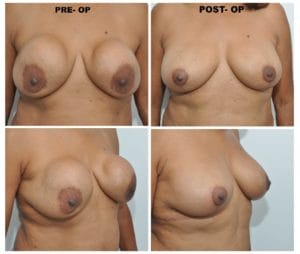plastic surgery in miami, breast augmentation in miami, transumbilical breast augmentation in miami, breast implant in miami breast lift in miami, breast reduction in miami,