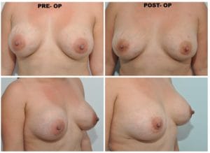 plastic surgery in miami, breast augmentation in miami, transumbilical breast augmentation in miami, breast implant in miami breast lift in miami, breast reduction in miami,