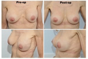 plastic surgery in miami, breast augmentation in miami, transumbilical breast augmentation in miami, breast implant in miami breast lift in miami, breast reduction in miami,