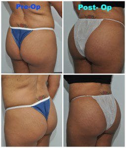 plastic surgery in miami, butt lift in miami, gluteoplasty in miami, brazilian butt lift in miami, butt augmentation in miami, butt lift gluteoplasty in miami