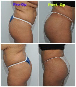 plastic surgery in miami, butt lift in miami, gluteoplasty in miami, brazilian butt lift in miami, butt augmentation in miami, butt lift gluteoplasty in miami