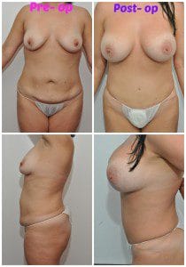 plastic surgery in miami, abdomen reduction in miami, tummy tuck in miami, abdominoplasty in miami, breast reduction in miami,