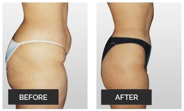 Plastic Surgery Miami, Board certified Plastic Surgeon Miami, Best Plastic Surgeons in Miami, Plastic Surgery Center Miami, Liposuction in Miami