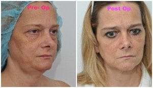 plastic surgery in miami, eyelid surgery in Miami, eye surgery in miami