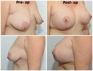 plastic surgery in miami, breast augmentation in miami, transumbilical breast augmentation in miami, breast implant in miami, breast lift in miami, liposuction in miami, laser liposuction in miami, liposculpture in miami, smartlipo in miami,