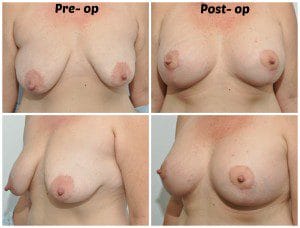 plastic surgery in miami, breast augmentation in miami, transumbilical breast augmentation in miami, breast implant in miami, breast lift in miami, liposuction in miami, laser liposuction in miami, liposculpture in miami, smartlipo in miami,