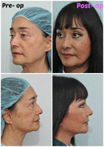 plastic surgery in miami, injectable dermal filler in miami, dermal filler in miami, facial rejuvenation in miami, facial rejuvenation with plasma in miami