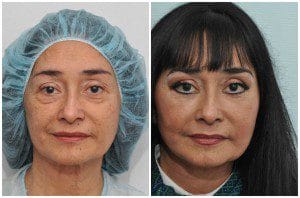 plastic surgery in miami, injectable dermal filler in miami, dermal filler in miami, facial rejuvenation in miami, facial rejuvenation with plasma in miami