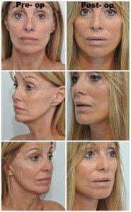 plastic surgery in miami, eyelid surgery in Miami, eye surgery in miami, dermal filler in miami, facial rejuvenation in miami, 
