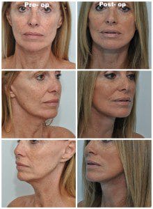 plastic surgery in miami, eyelid surgery in Miami, eye surgery in miami, dermal filler in miami, facial rejuvenation in miami, 