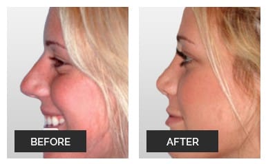 Expects after a rhinoplasty in Miami