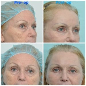 plastic surgery in miami, injectable dermal filler in miami, dermal filler in miami, facial rejuvenation in miami, facial rejuvenation with plasma in miami