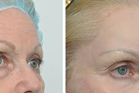 plastic surgery in miami, injectable dermal filler in miami, dermal filler in miami, facial rejuvenation in miami, facial rejuvenation with plasma in miami