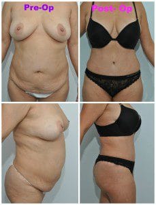 plastic surgery in miami, abdomen reduction in miami, tummy tuck in miami, abdominoplasty in miami