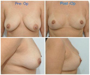 plastic surgery in miami, breast augmentation in miami, transumbilical breast augmentation in miami, breast implant in miami breast lift in miami, breast reduction in miami,