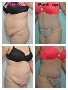 plastic surgery in miami, abdomen reduction in miami, tummy tuck in miami, abdominoplasty in miami, liposuction in miami, laser liposuction in miami, liposculpture in miami, smartlipo in miami