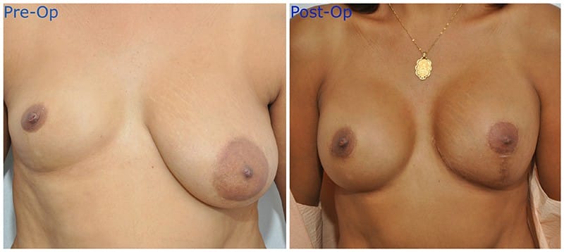 Repair of asymmetric breasts