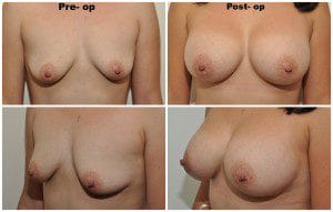 plastic surgery in miami, breast augmentation in miami, transumbilical breast augmentation in miami, breast implant in miami,
