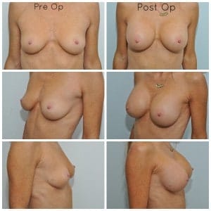Breast Augmentation WITHOUT scars on your breast!!