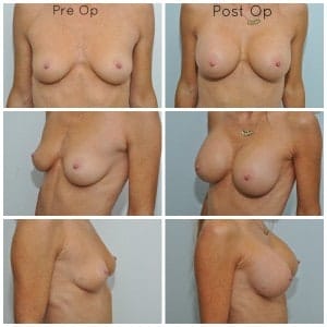 plastic surgery in miami, breast augmentation in miami, transumbilical breast augmentation in miami,