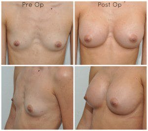 plastic surgery in miami, breast augmentation in miami, transumbilical breast augmentation in miami,