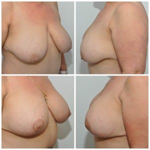 Breast reduction with implants