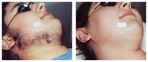 plastic surgery in miami, laser hair removal in miami, 