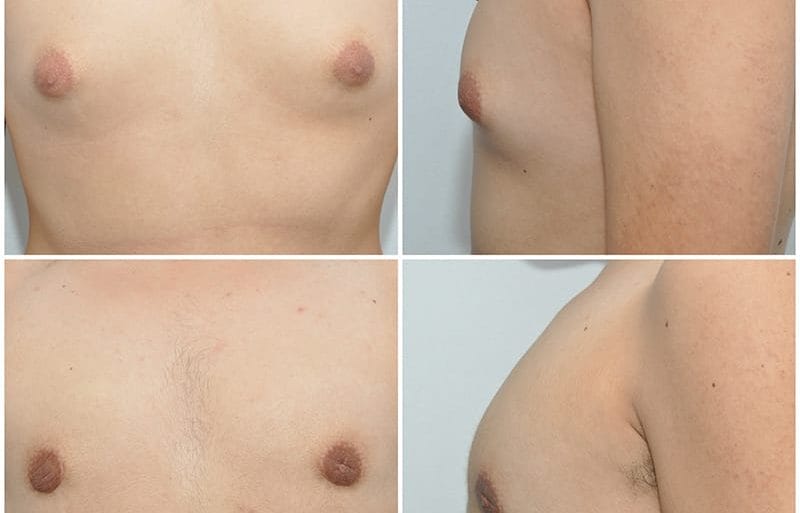 Enlargement of the breasts in males (Gynecomastia)