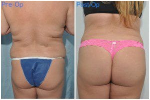 plastic surgery in miami, butt lift in miami, gluteoplasty in miami, brazilian butt lift in miami, butt lift gluteoplasty in miami