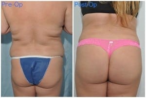 Good news about brazilian butt lift procedure