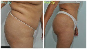 plastic surgery in miami, butt lift in miami, gluteoplasty in miami, brazilian butt lift in miami, butt lift gluteoplasty in miami