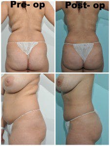 plastic surgery in miami, butt lift in miami, gluteoplasty in miami, brazilian butt lift in miami, butt lift gluteoplasty in miami