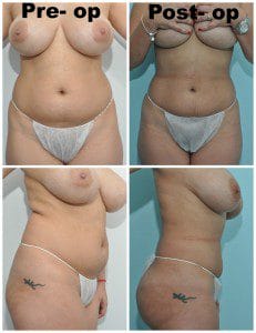 plastic surgery in miami, butt lift in miami, gluteoplasty in miami, brazilian butt lift in miami, butt lift gluteoplasty in miami