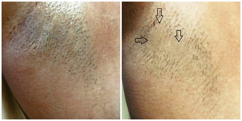 Laser hair removal with The Candela ND:YAG