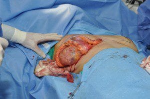 plastic surgery in miami, breast lift in miami, breast reduction in miami, breast implant in miami,