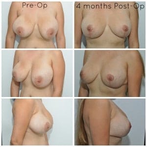 plastic surgery in miami, breast lift in miami, breast reduction in miami, breast implant in miami, 