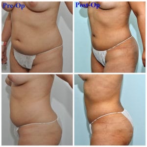 plastic surgery in miami, liposuction in miami, laser liposuction in miami, liposculpture in miami, smartlipo in miami